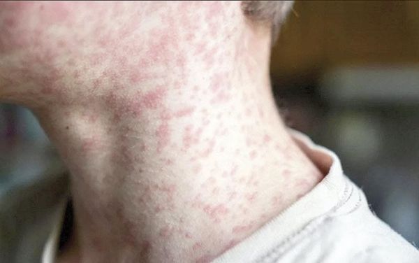 ¡SSA CONFIRMA 17 MUERTES POR SARAMPIÓN EN MÉXICO!