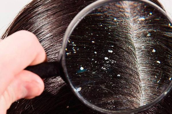 TIPS PARA MEJORAR TU CALIDAD DE VIDA | LA CASPA. PRIMERA PARTE - Las cifras recientes del Sector Salud revelan que aproximadamente tres millones de individuos en México padecen caspa, enfermedad...