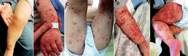 ¡ATACA EL VIRUS COXSACKIE!