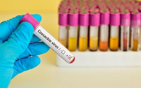 ¡VIRUS COXSACKIE EN VERACRUZ! - *Hay 71 casos atendidos en escuelas