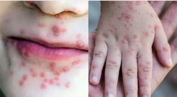 ¡ATACA EL VIRUS COXSACKIE, HAY 71 CASOS! - *Con mayor incidencia en 2025 y casos concentrados en Xalapa y Veracruz