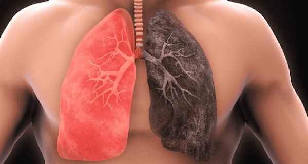 TIPS PARA MEJORAR LA CALIDAD DE VIDA | Bronquitis - La bronquitis aguda es la inflamación del árbol traqueobronquial, comúnmente después de una infección de las vías aéreas superiores, en ausencia de trastornos...