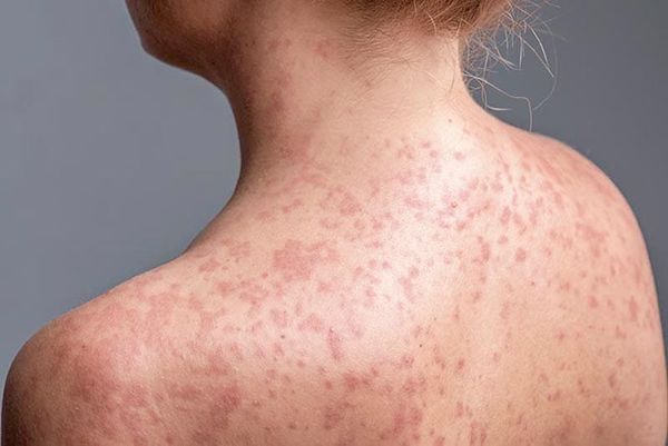 ¡URGE RETOMAR LA VACUNACIÓN! - POS’CLARO