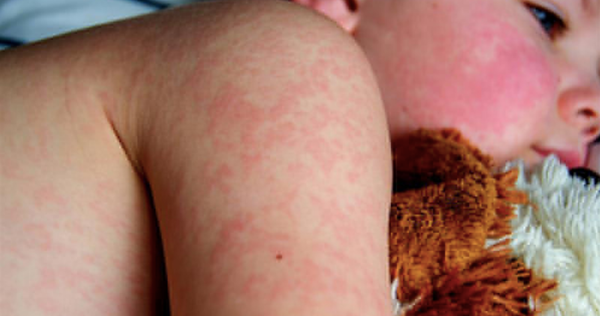 ¡YA SON 21! - *Casos de sarampión