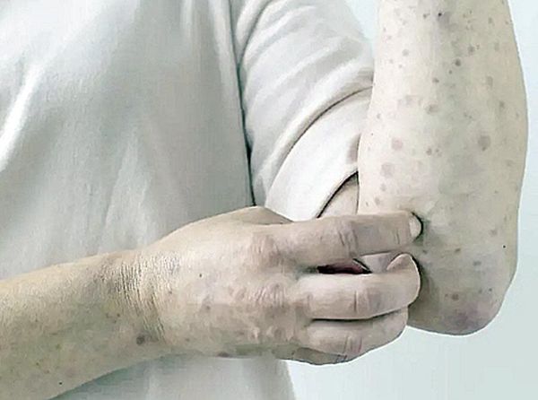 ¡PUEBLA ACUMULA 205 CASOS DE SARAMPIÓN EN 2026!