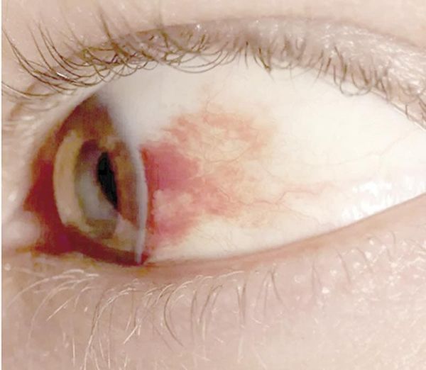 ¡UNAM DESARROLLA GOTAS CONTRA LA CEGUERA POR DIABETES!