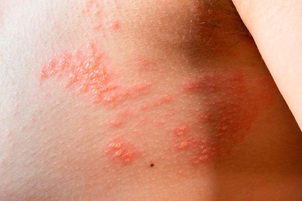 TIPS PARA MEJORAR TU CALIDAD DE VIDA | LA SARNA 2 - Continuamos con el tema de la sarna y te puedo decir que con el paso del tiempo, los surcos pueden resultar difíciles de ver, ya que quedan enmascarados por la inflamación producida por el rascado…