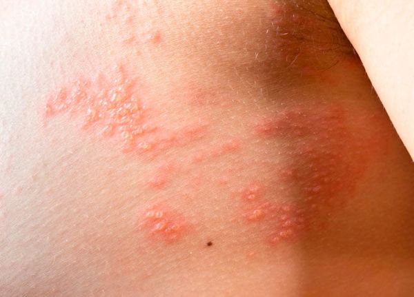 TIPS PARA MEJORAR TU CALIDAD DE VIDA | LA SARNA 1 - Una gran parte de los parásitos cutáneos son diminutos insectos o gusanos que se esconden dentro de la piel haciendo de ella su hábitat natural -Algunos de estos parásitos viven en la piel durante…