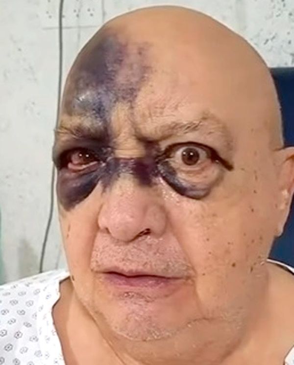 ¡SE ACCIDENTA LUIS DE ALBA!