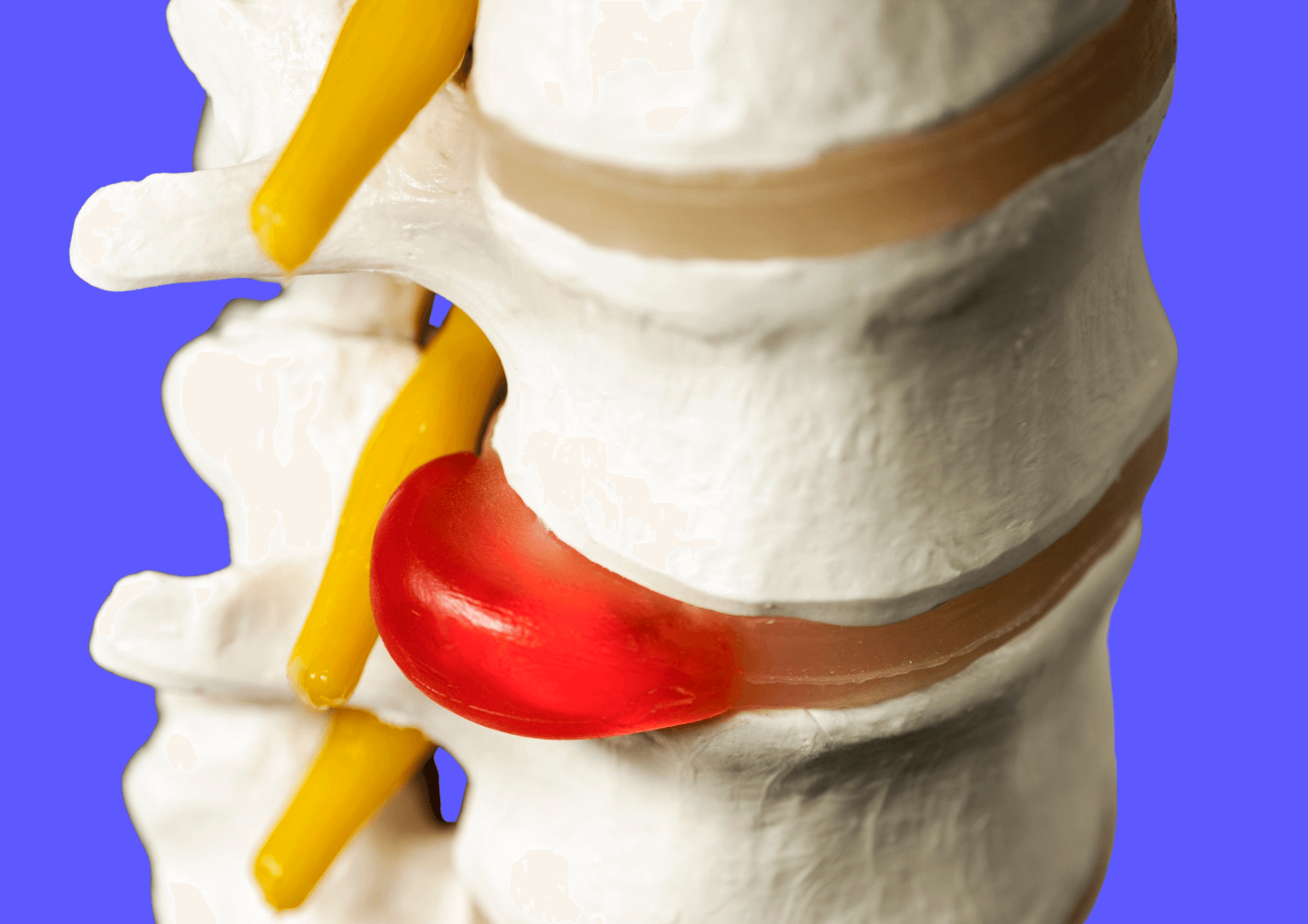 Image of a spine with herniated disc.