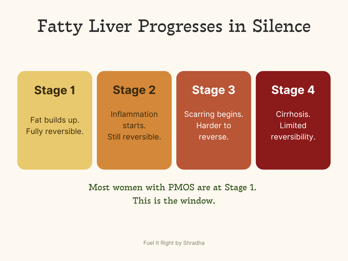 Fatty liver progresses in silence — four stages from fully reversible fat buildup to cirrhosis, most women with PMOS are at Stage 1 which is the window for reversal