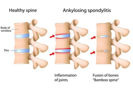 Ankylosing Spondylitis symptoms, causes, and treatments