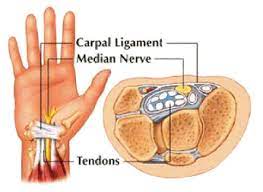 Carpal tunnel syndrome causes, symptoms, and treatments