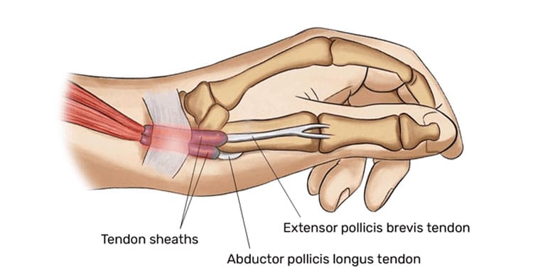 DeQuervain`s Tenosynovitis causes, symptoms, and treatments