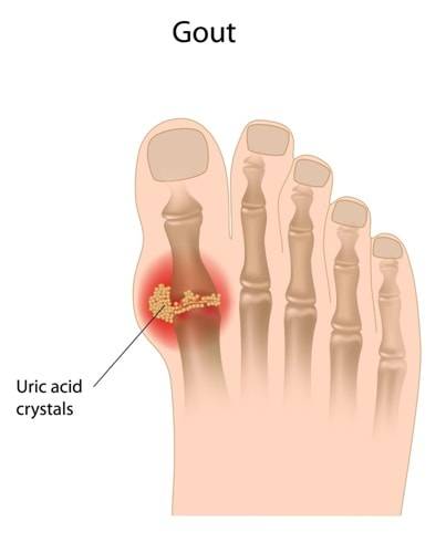 GOUT cause and treatments