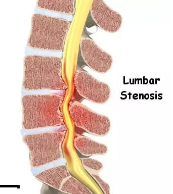 Lumbar Spondylosis