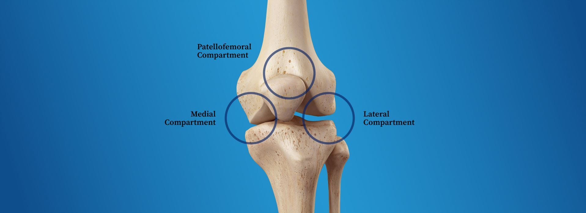 Osteoarthritis of the knee