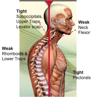 FORWARD HEAD POSTURE |  Causes, and Effective Treatments