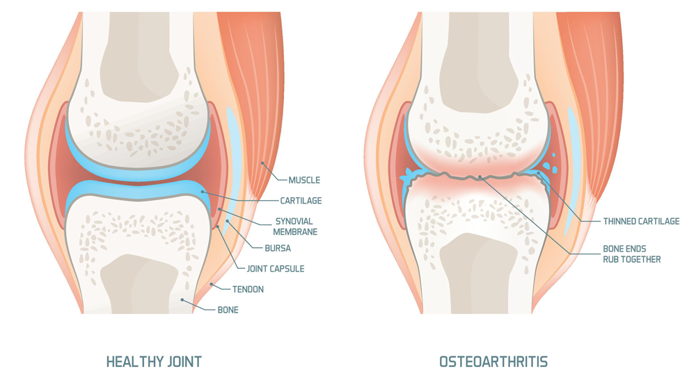 Osteoarthritis causes, symptoms, and treatments