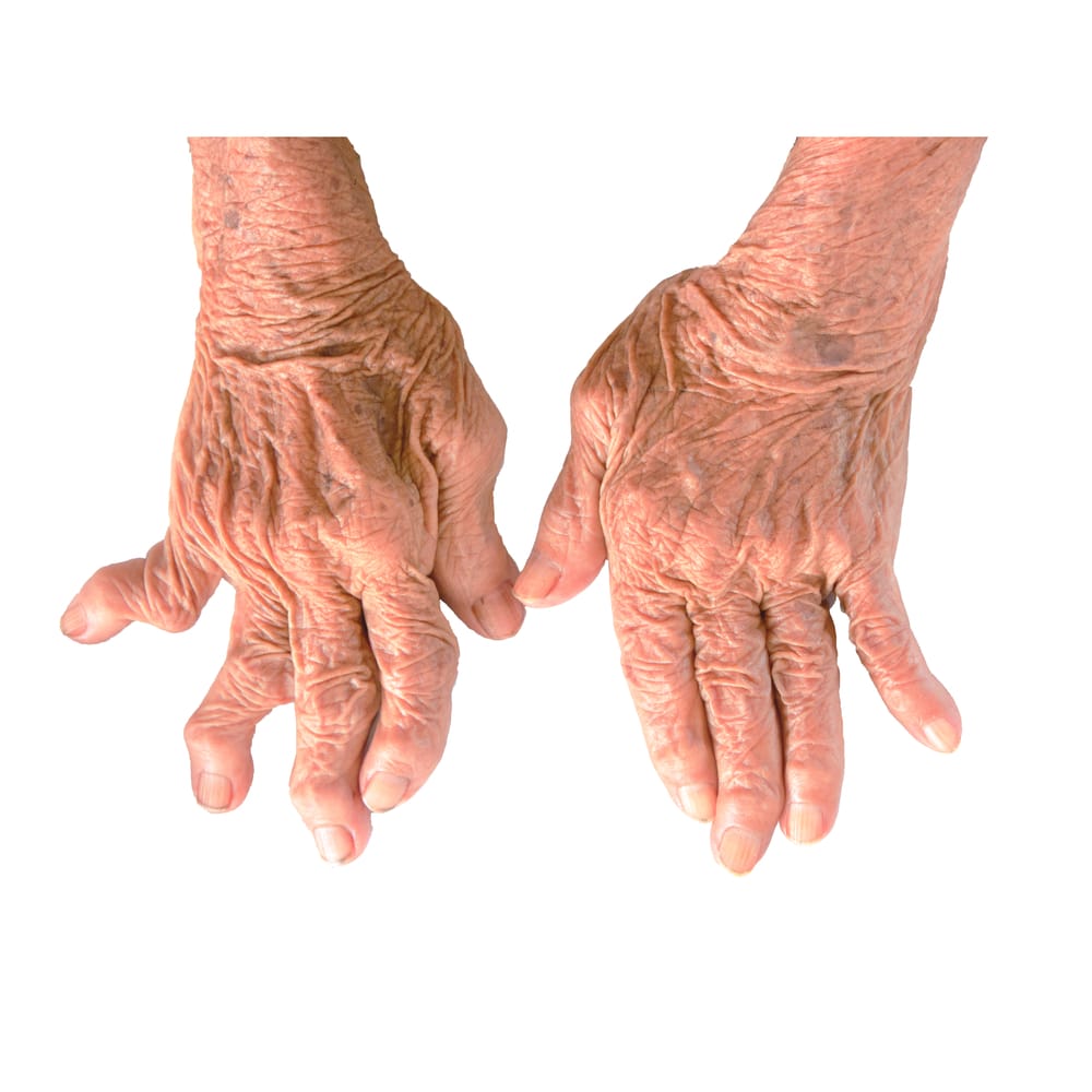 Rheumatoid arthritis causes, symptoms and treatments