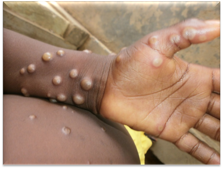 Mpox: Causes, symptoms, Diagnosis, and prevention