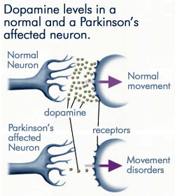 Treatments for Parkinson's disease
