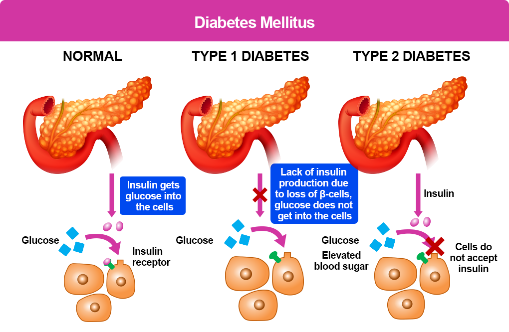 Introduction to Diabetes Mellitus