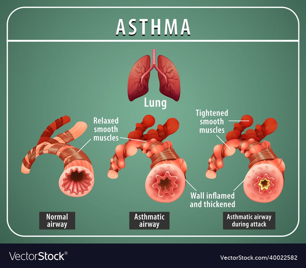 Bronchial Asthma