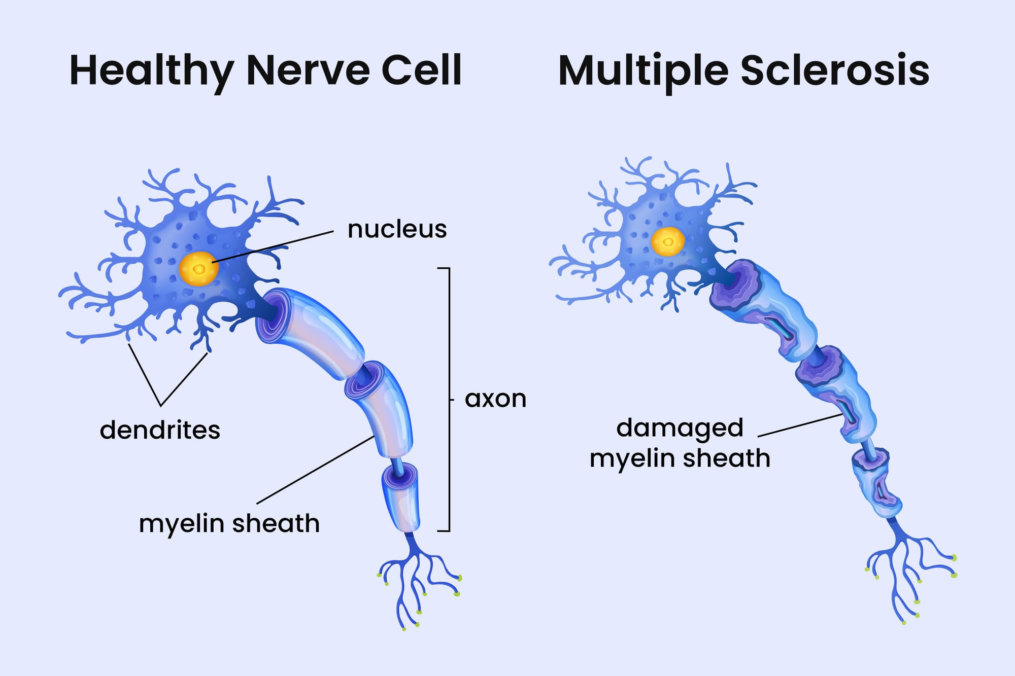 MULTIPLE SCLEROSIS