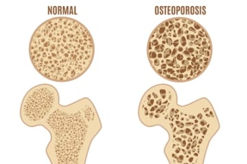 Osteoporosis - Causes, Symptoms, and Diagnosis