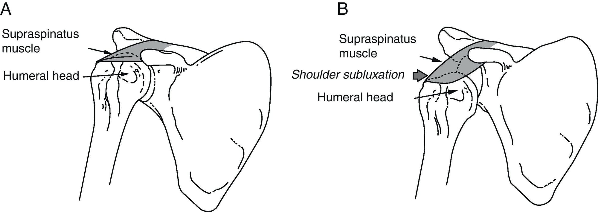 Shoulder Subluxation