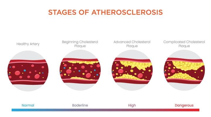 ATHEROSCLEROSIS and symptoms