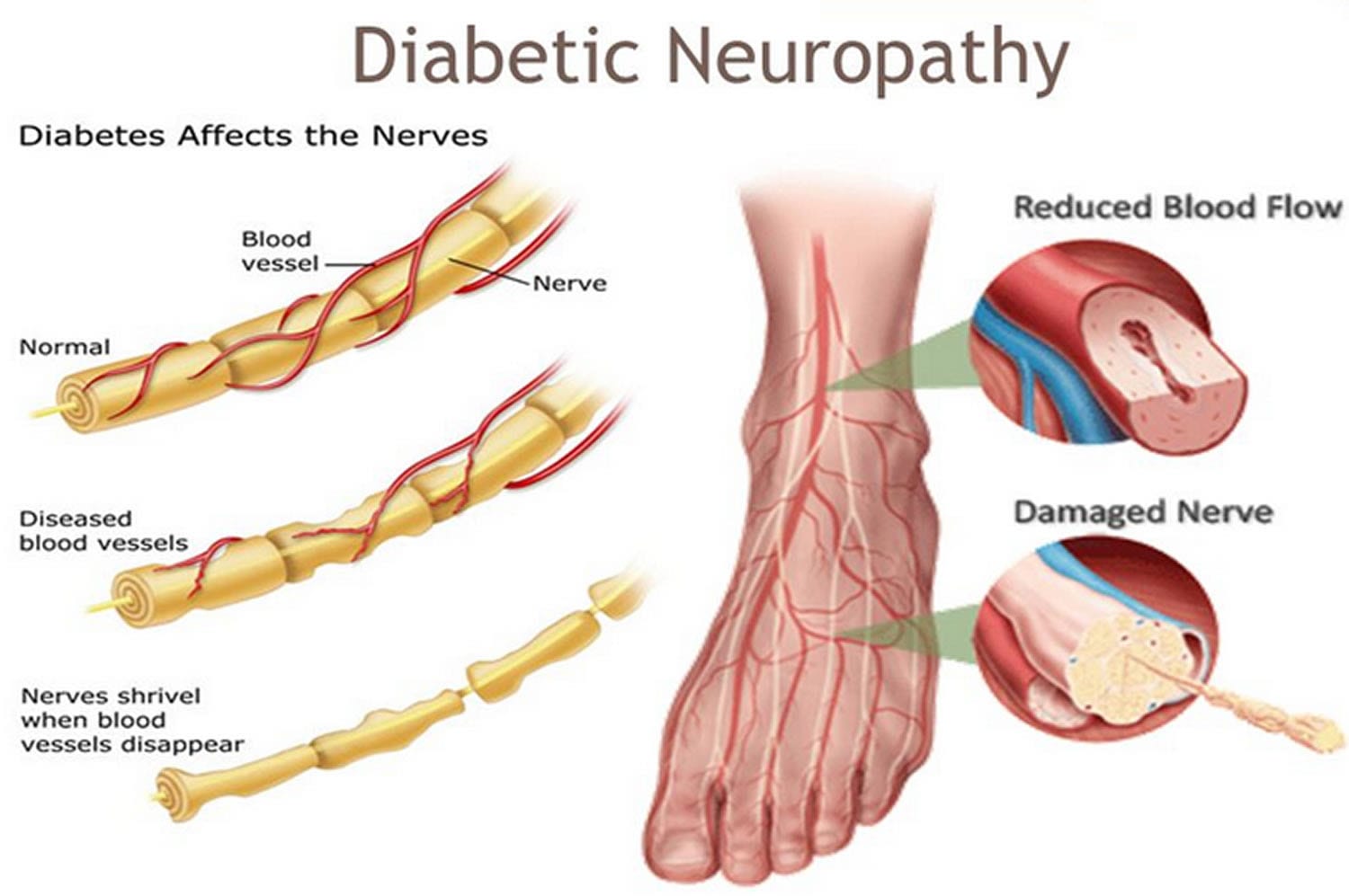 DIABETIC NEUROPATHY and symptoms