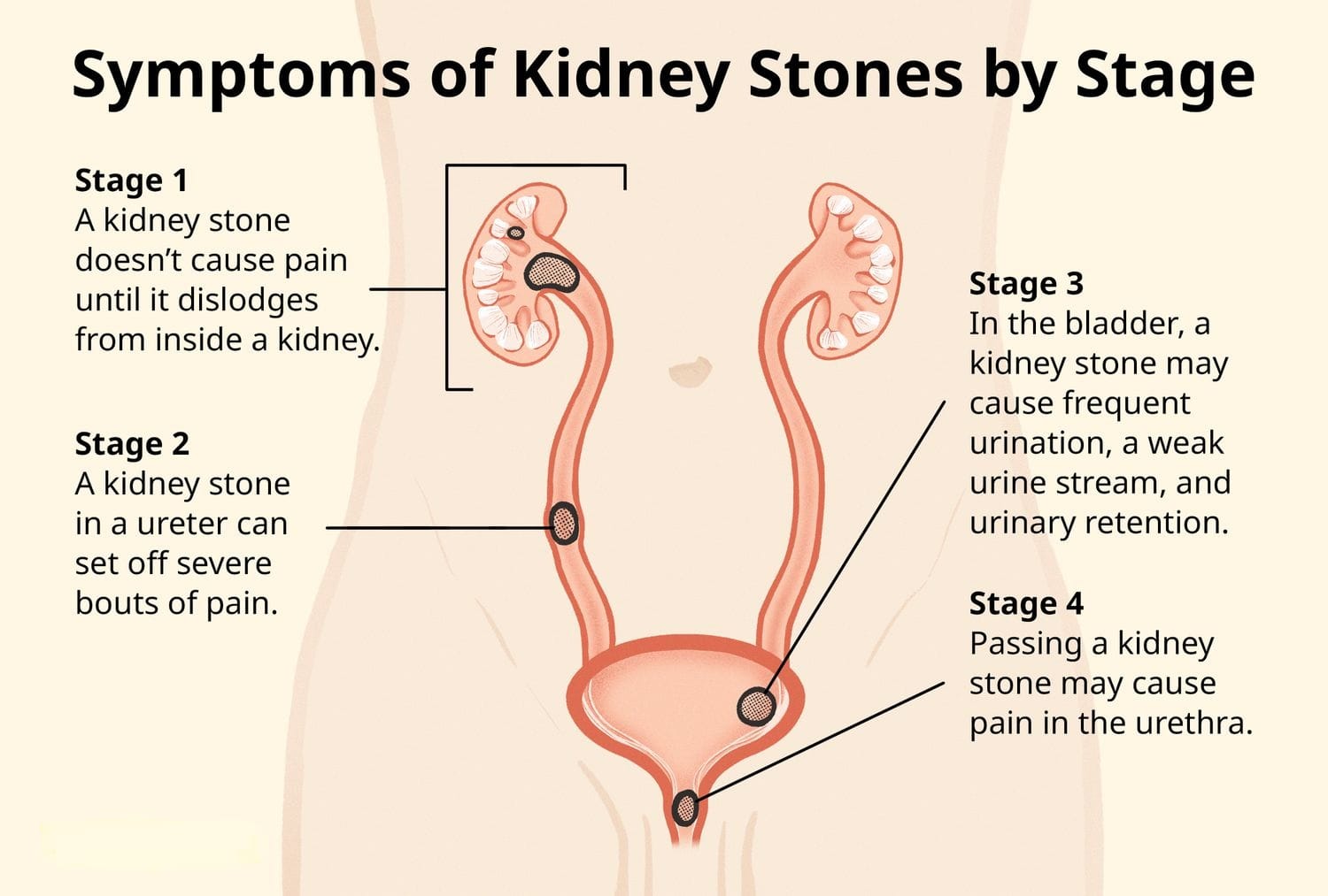 KIDNEY STONES and Symptoms