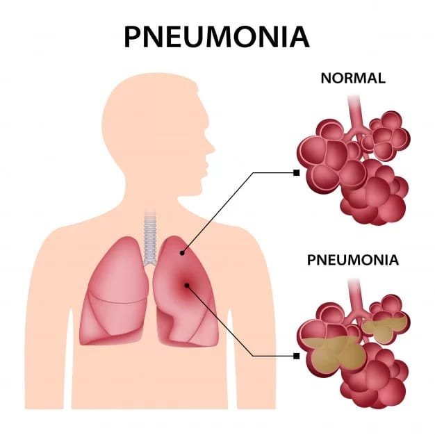 PNEUMONIA and Symptoms