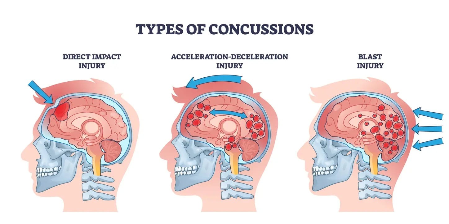 Symptoms of CONCUSSION