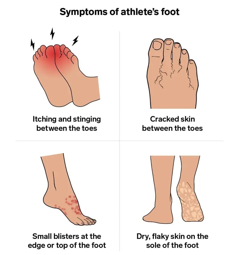 ATHLETE`S FOOT