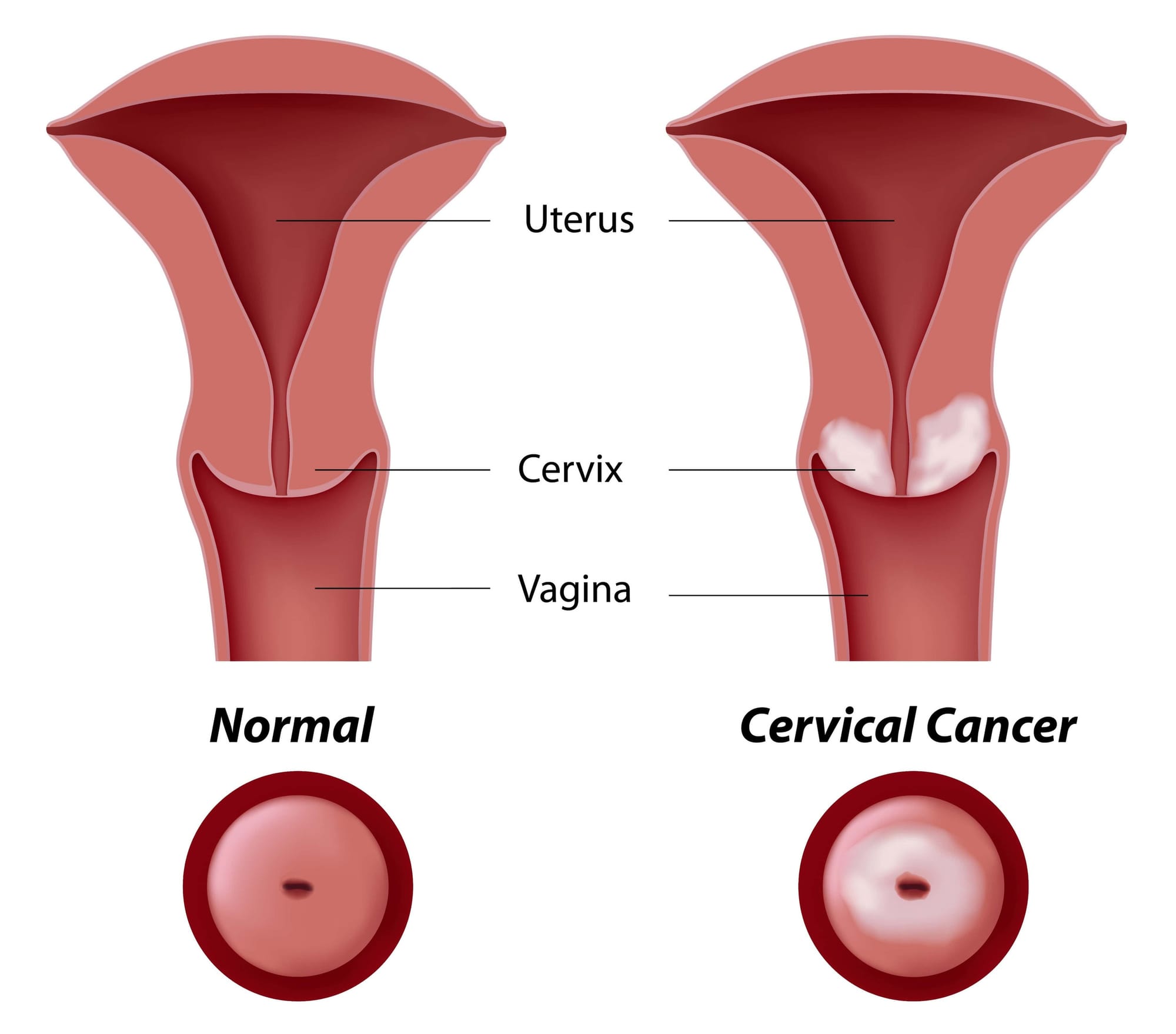 CERVICAL CANCER