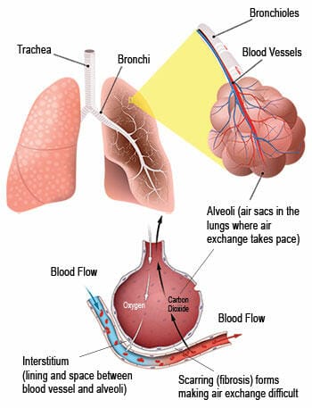 INTERSTITIAL LUNG DISEASE: symptoms, digonosis, and treatment