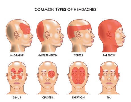 Headache – A symptom