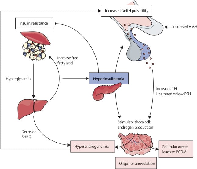 Does exercise positively impact hormonal imbalance in polycystic ovarian syndrome?