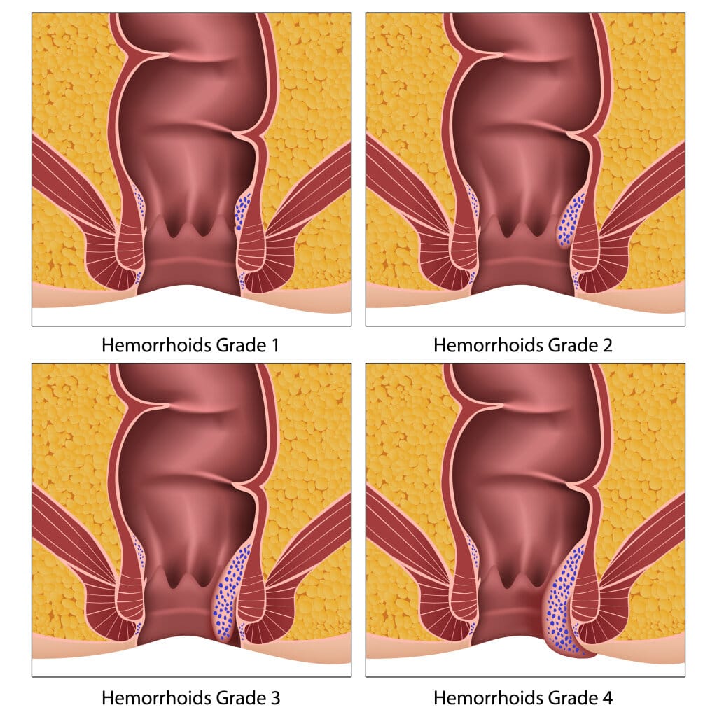 Hemorrhoids