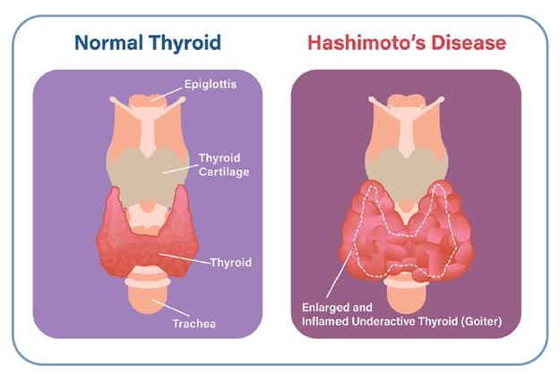 HASHIMOTO`S THYROIDITIS