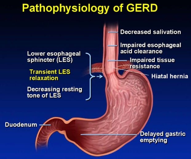 Gastroesophageal reflux disease