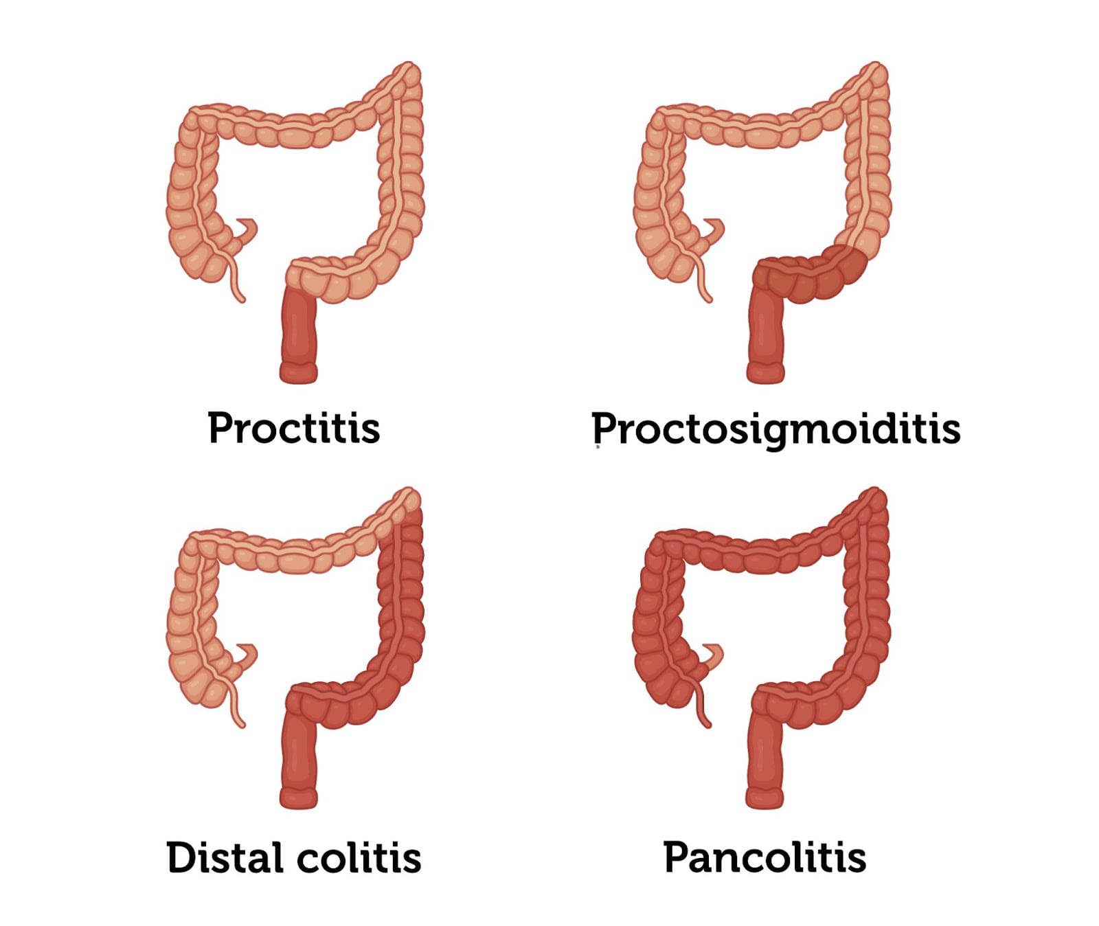 Ulcerative Colitis: Symptoms, Diagnosis, and Treatment