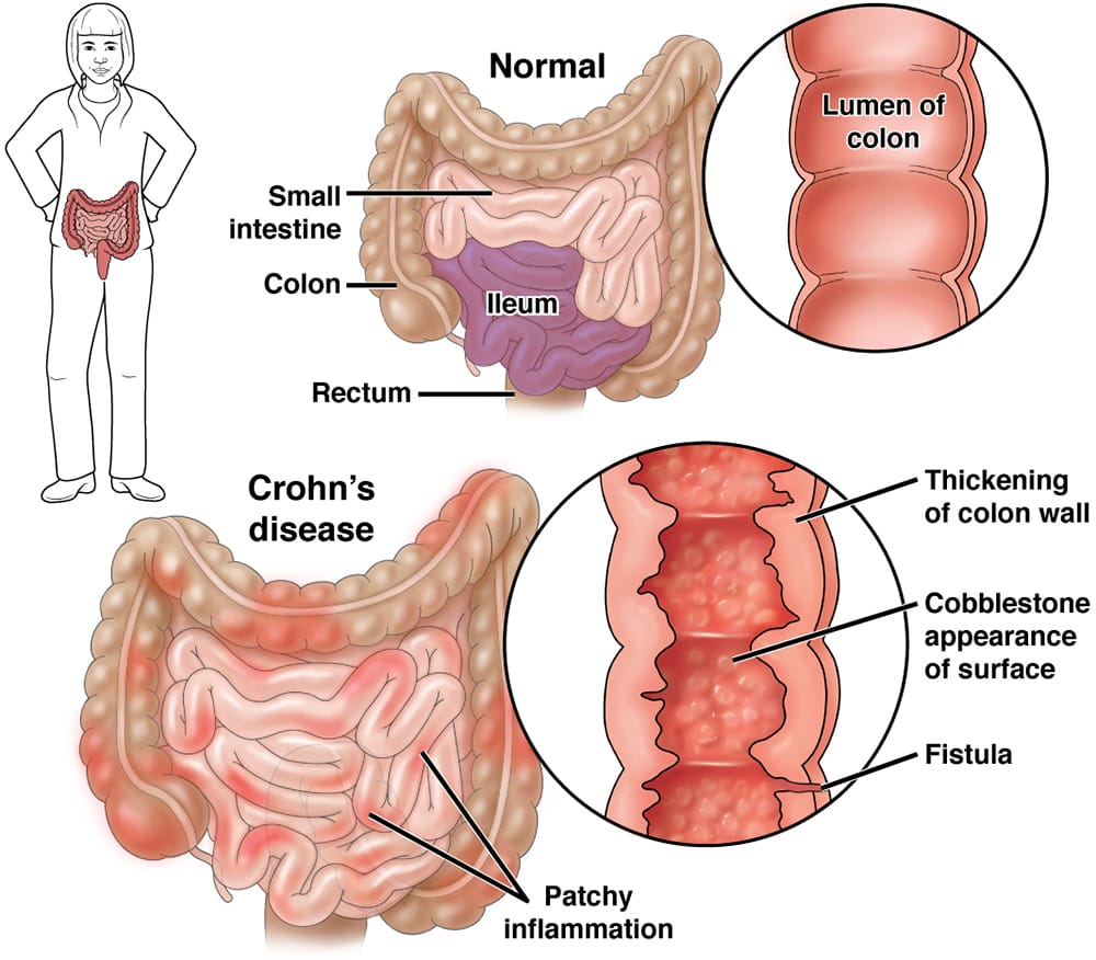 Crohn's Disease: Causes, Symptoms, and Treatment