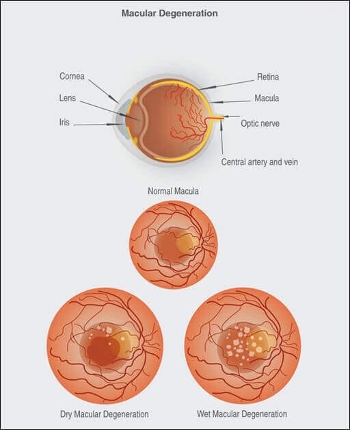 MACULAR DEGENERATION