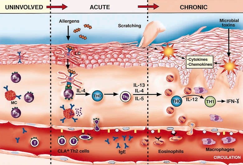 ATOPIC DERMATITIS