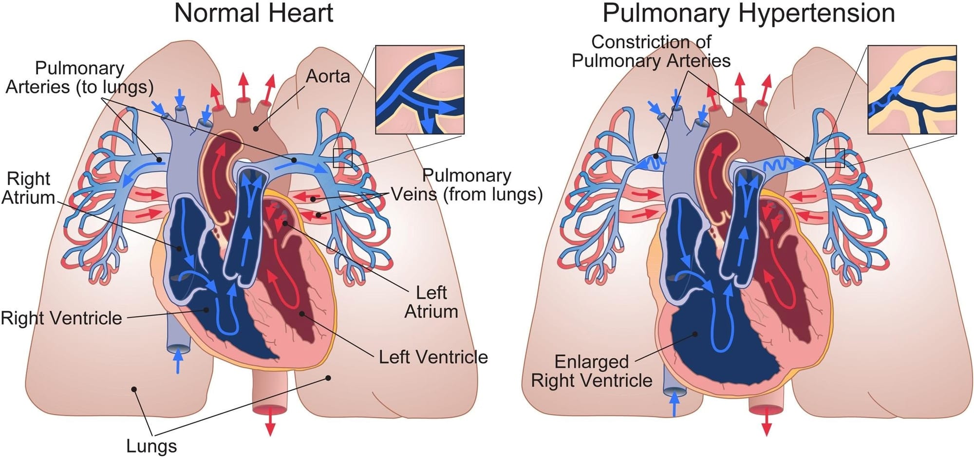 Pulmonary Hypertension: Symptoms, diagnosis, and treatment