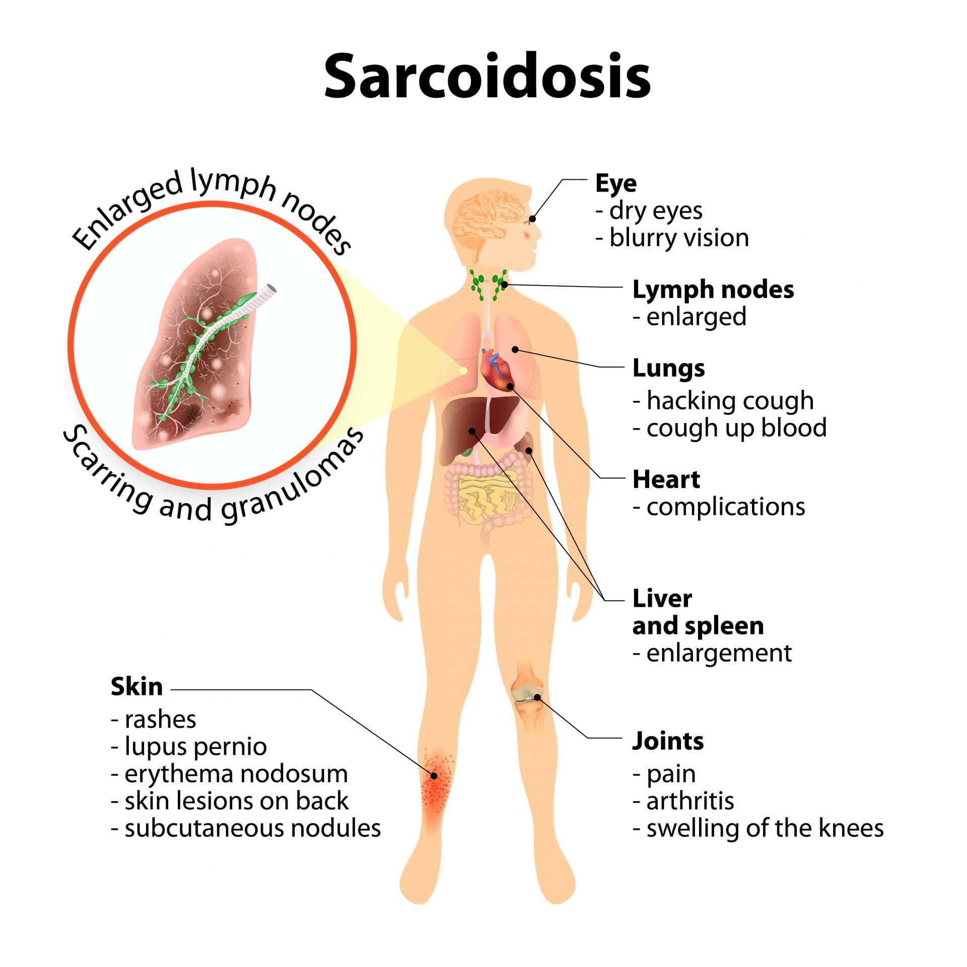 Sarcoidosis: symptoms, diagnosis, and treatment
